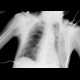 Thoracoplasty: X-ray - Plain radiograph
